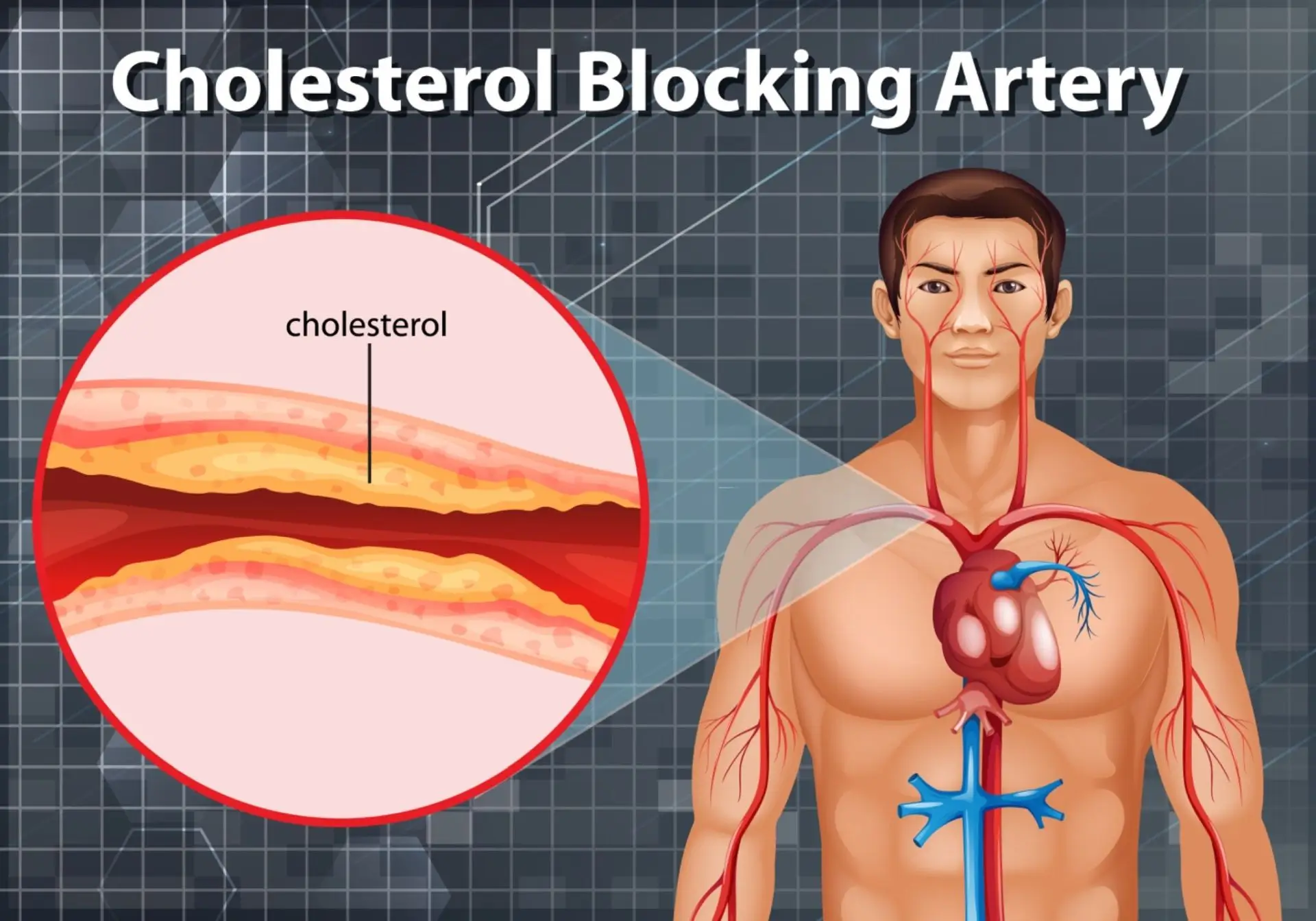 choresterol blocking artery